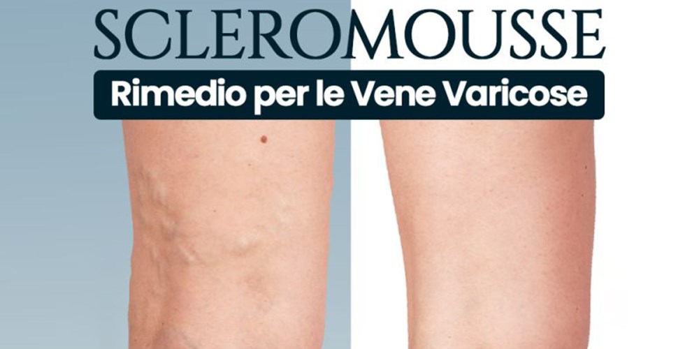 Scleromousse: rimedio per le vene varicose