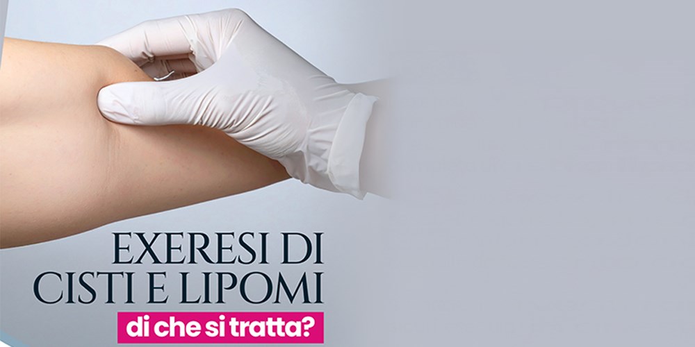 Exeresi di cisti e lipomi, di che si tratta?